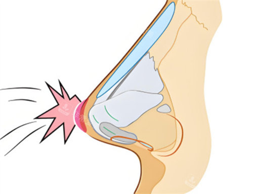 隆鼻修復(fù)碰撞成因