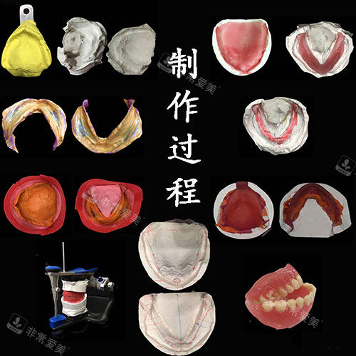 吸附性义齿制作过程示意图