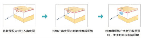 玻尿酸塑型原理