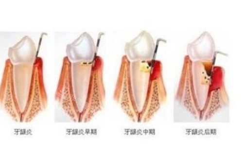 牙髓炎的发展过程