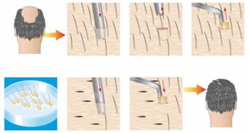 毛囊移植步驟動畫演示圖