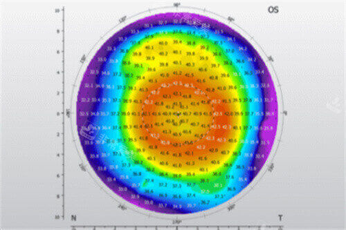 角膜地形图