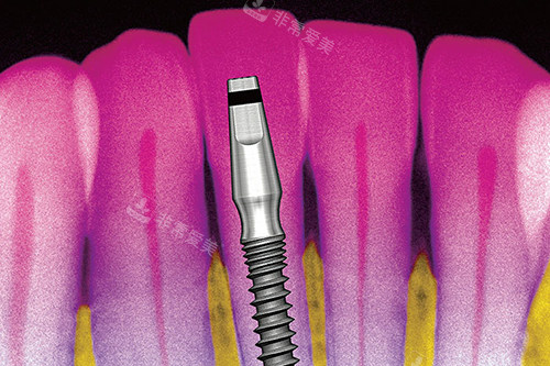 超细种植体卡通外观示意图 超细种植体卡通外观示意图