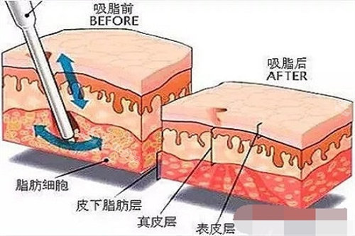 吸脂前后脂肪对比图