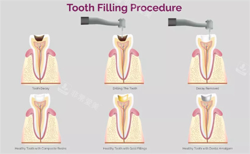 补牙过程图