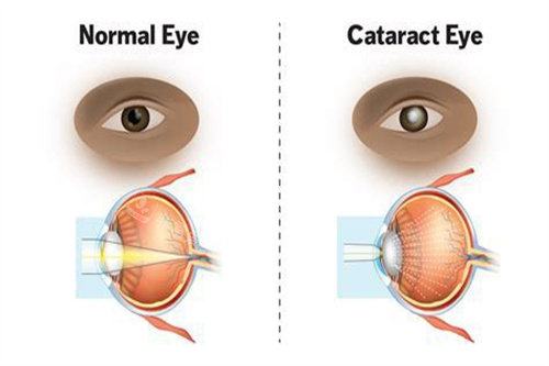 白内障与正常眼对比