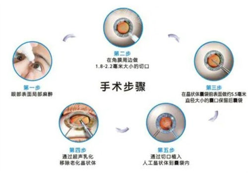 白内障手术步骤