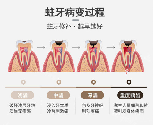 蛀牙的病变过程