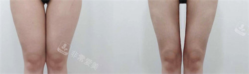 韓國(guó)reberry皮膚#2Y*&x*b腿+臀線+膝蓋吸脂+Onda提升激光前后對(duì)比圖