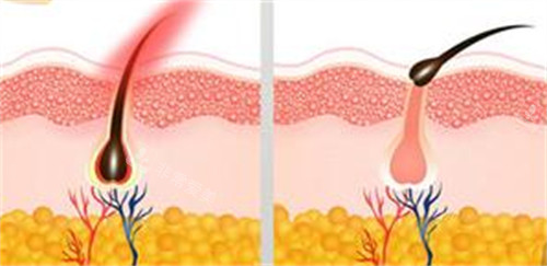脱毛前后毛囊的变化