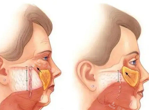 面部筋膜层拉皮提升卡通示意图