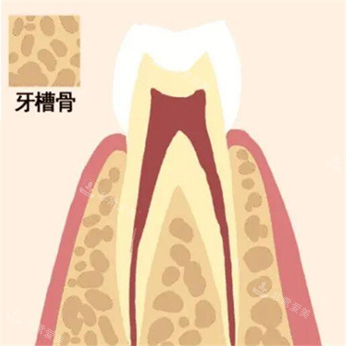 牙槽骨缺失卡通图