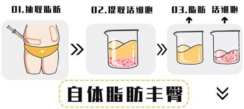 自體脂肪移植過程 自體脂肪移植過程