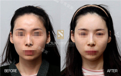 Signature整形填充額頭和鼻子對(duì)比照片 Signature整形填充額頭和鼻子對(duì)比照片