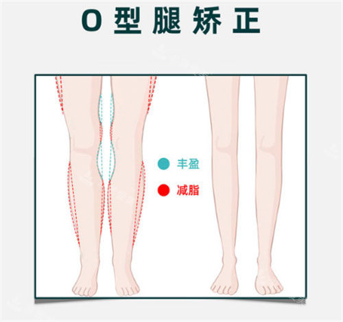 O型腿矫正对比图