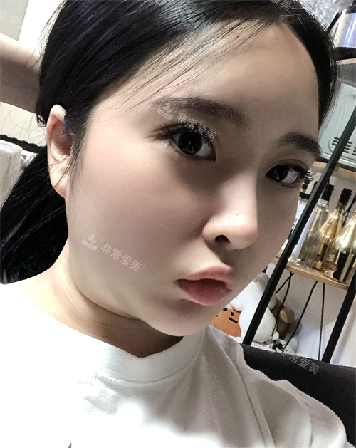 韓國Signature整形外科雙下巴吸脂前 韓國Signature整形外科雙下巴吸脂前