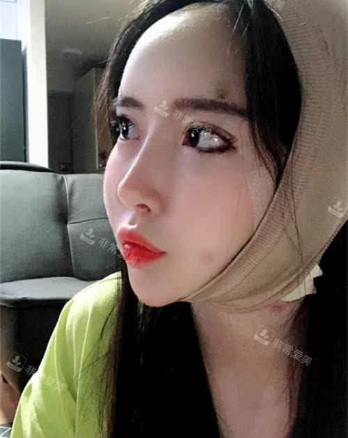 韓國Signature整形外科雙下巴吸脂改善期 韓國Signature整形外科雙下巴吸脂改善期