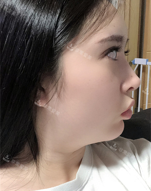 韓國Signature整形外科雙下巴吸脂前側面 韓國Signature整形外科雙下巴吸脂前側面