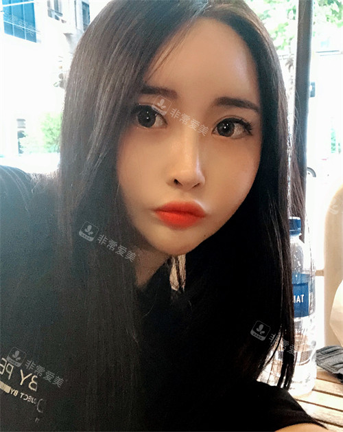韓國Signature整形外科術后日常 韓國Signature整形外科術后日常