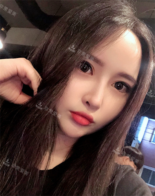 韓國Signature整形外科雙下巴吸脂后的樣子 韓國Signature整形外科雙下巴吸脂后的樣子