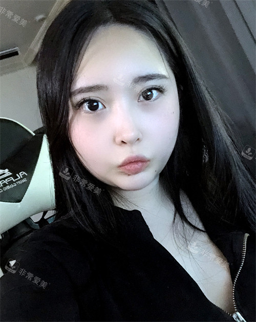 韓國Signature整形外科雙下巴吸脂 韓國Signature整形外科雙下巴吸脂