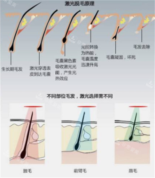 激光脱毛前后对比