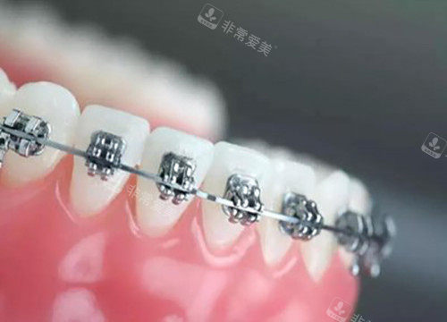 唇侧矫治器示意图