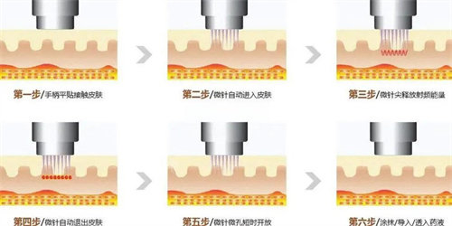 看看我在韩国做韩国potenza黄金微针多少钱一次?get了韩女水光肌的秘密~