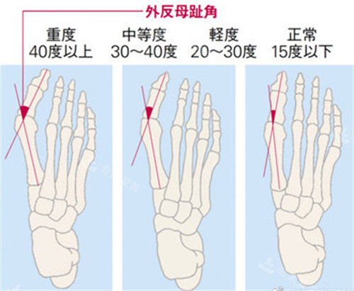 大脚骨的不同形态