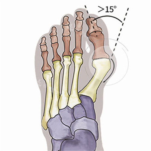 大脚骨的症状
