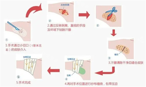 去腋臭手术过程