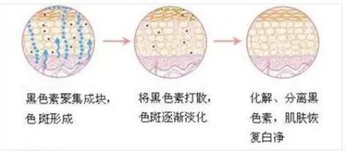 激光祛斑一次就非常明显！看来韩国的皮肤科和医美技术确实更好！