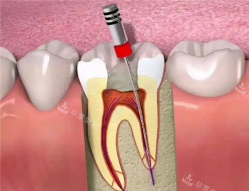 根管治疗动画模拟图