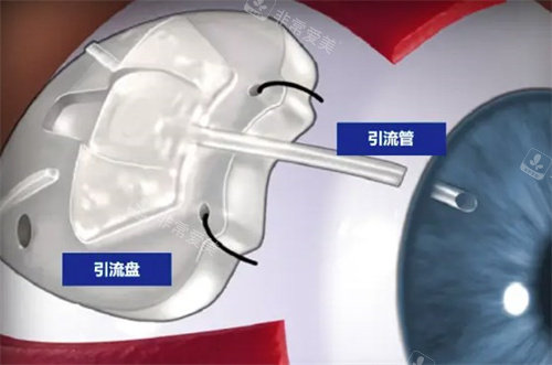 青光眼引流阀
