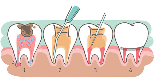 牙齿根管治疗步骤