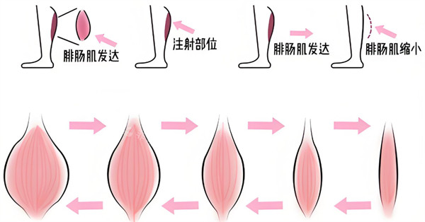 注射瘦小腿原理 注射瘦小腿原理