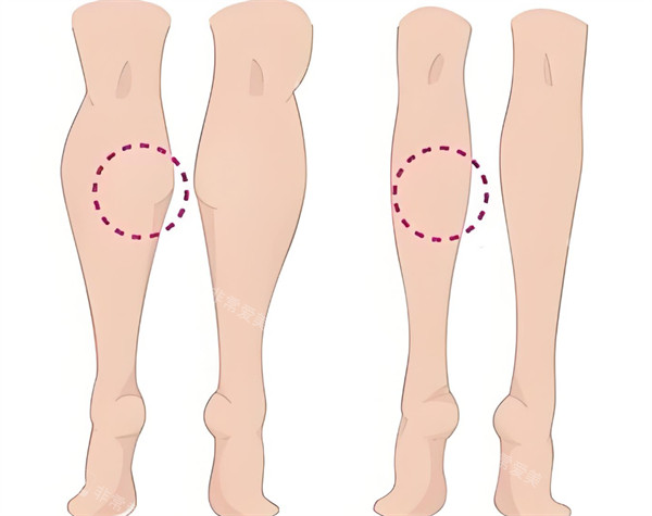 瘦腿针前后对比