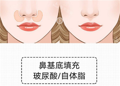 鼻基底填充前后對比圖 鼻基底填充前后對比圖