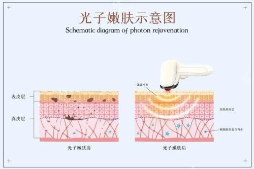 光子嫩膚的示意圖