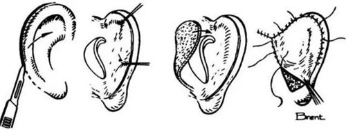 耳再造手术过程