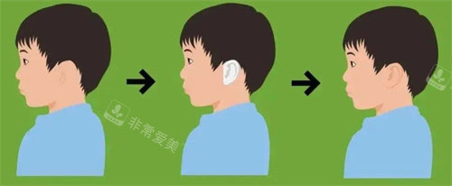 小耳畸形手术前后对比 小耳畸形手术前后对比