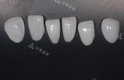 牙齿贴面修复改善