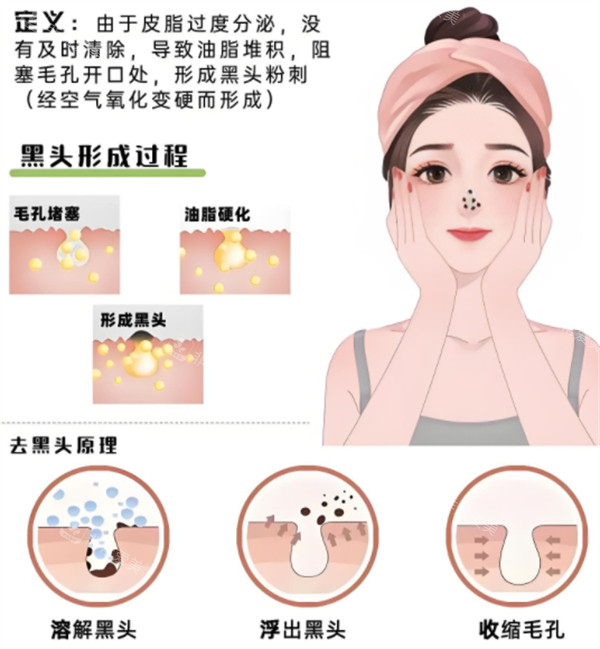 去黑頭原理 去黑頭原理