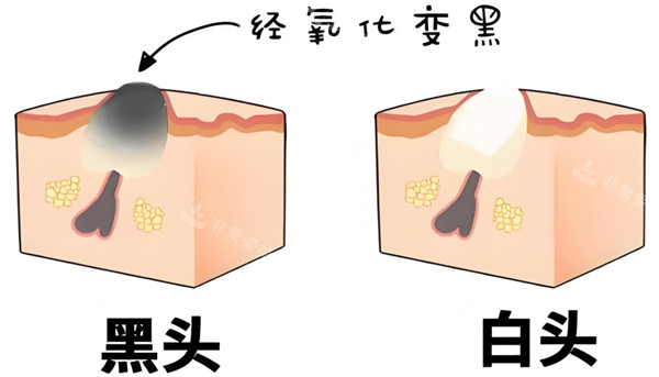 白头粉刺变黑头粉刺的过程