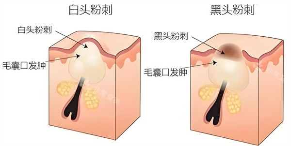 白头粉刺和黑头粉刺对比