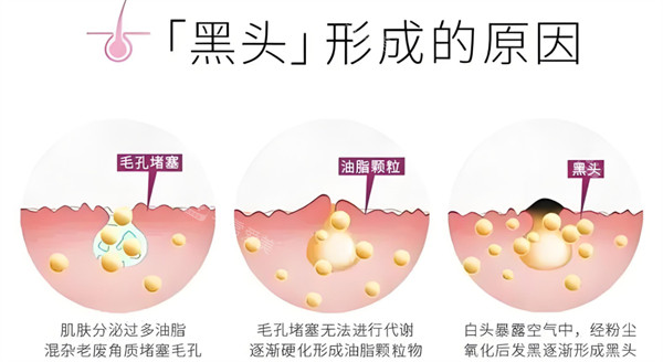 黑頭形成的原因 黑頭形成的原因