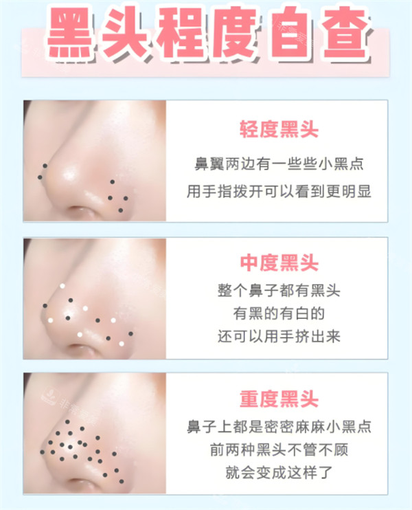 黑頭的程度 黑頭的程度