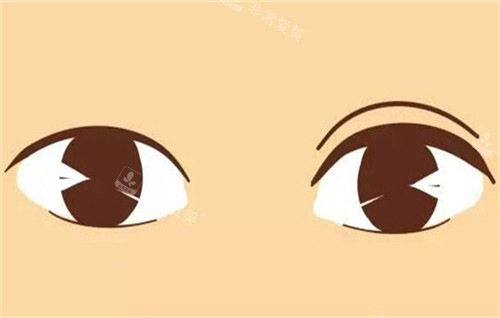雙眼皮手術的前后對比