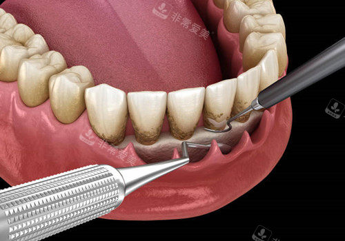 牙周刮治动画图