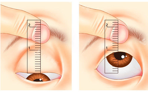 眼瞼是否下垂自測圖